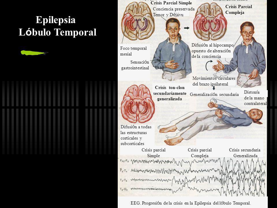 epilepsia del lobulo temporal mesial